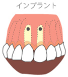 インプラント