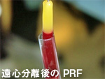 インプラント1