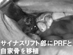 インプラント3