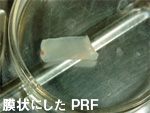 インプラント4