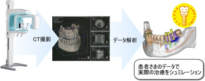 歯科用ＣＴ