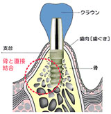 インプラント
